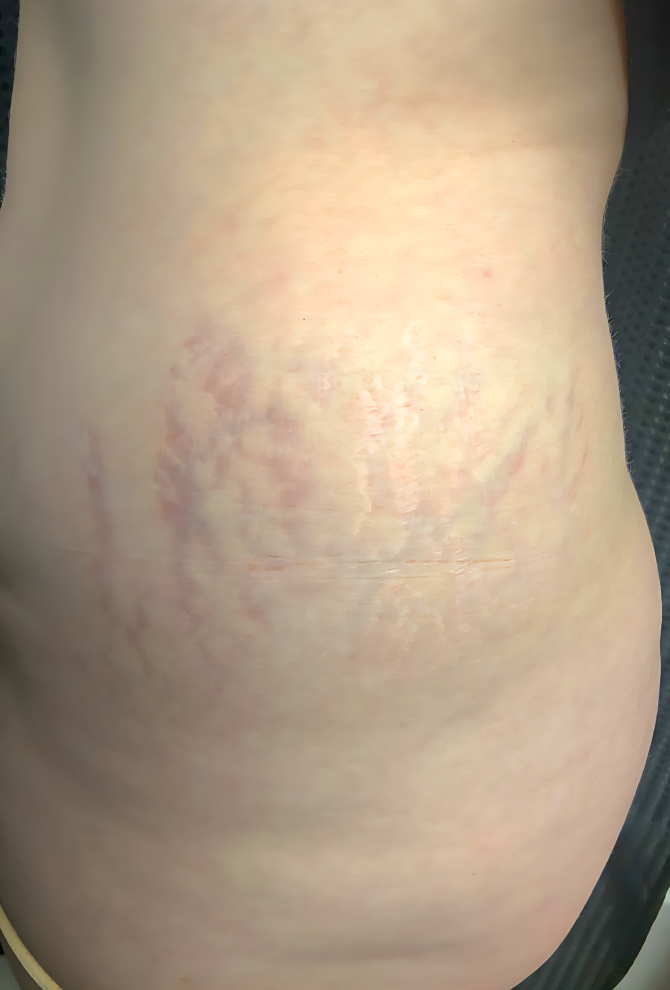 ReCoverDerm Hyperpigmentation Lightening