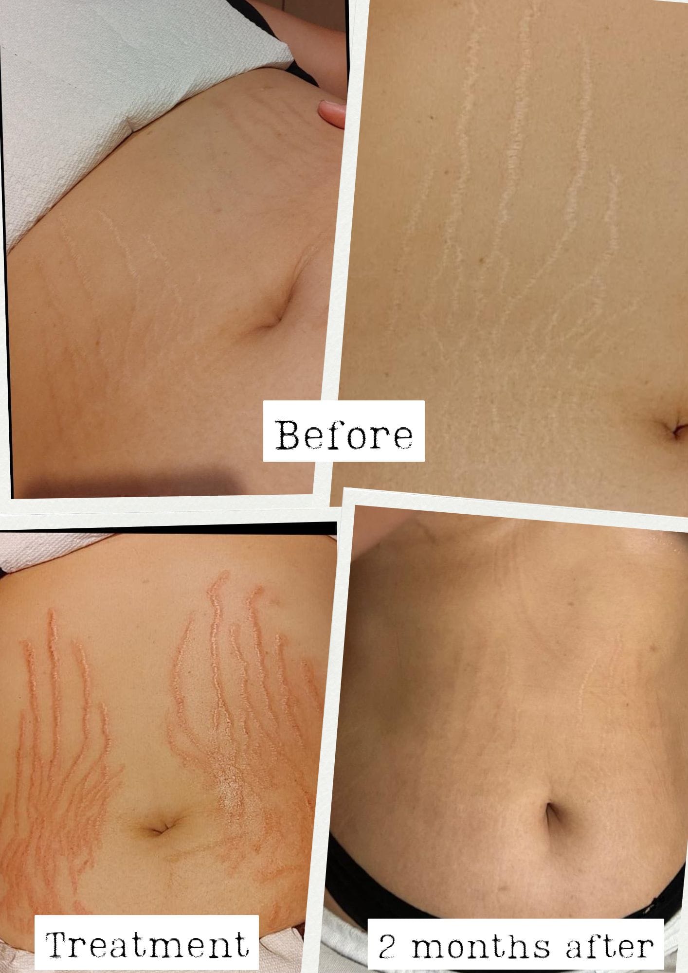 ReCoverDerm Stretch Mark Revision