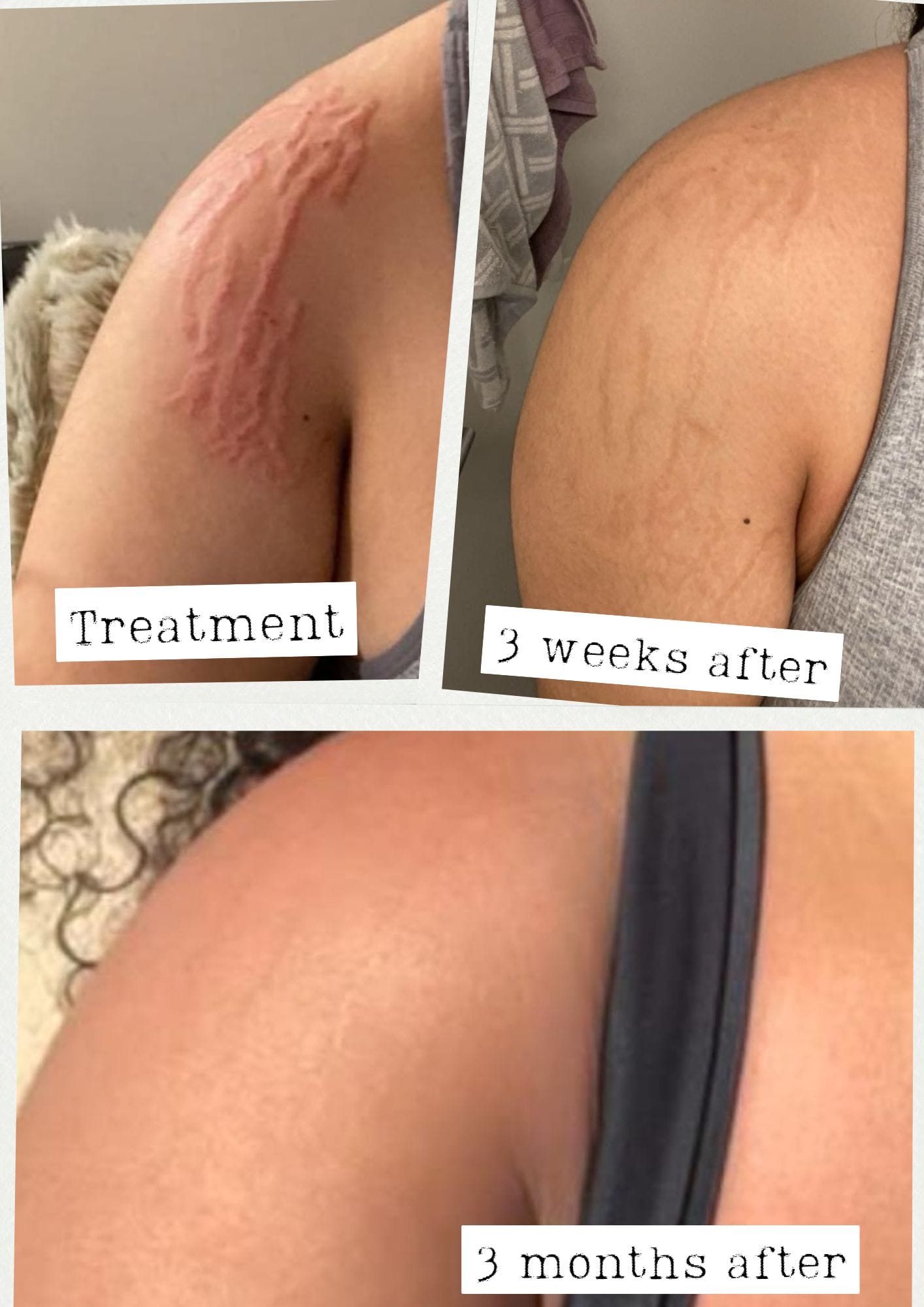 ReCoverDerm Stretch Mark Revision